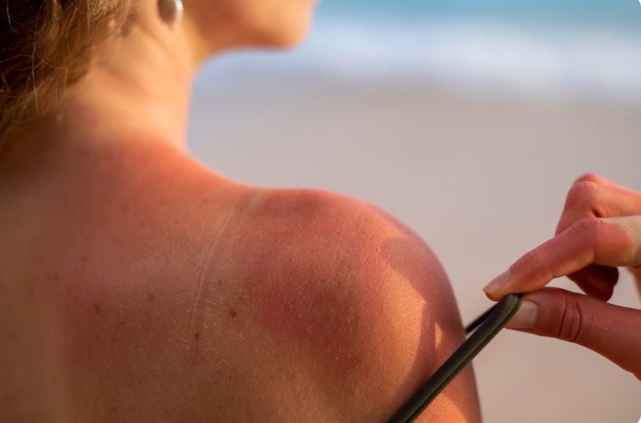 Sun Poisoning Symptoms